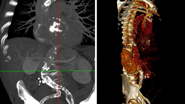 TAVI: when calcifications are the major issues