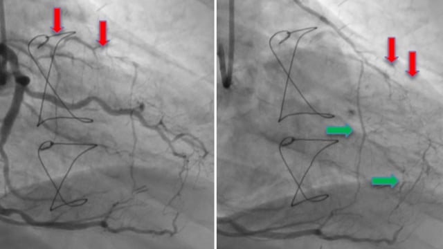 The big challenge: CTO post-CABG