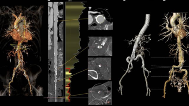 The challenges of femoral access