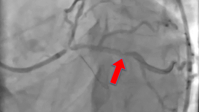 Tough calls during complex PCI