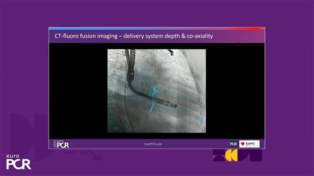 Transformative imaging in the clinical pathway of transcatheter tricuspid valve interventions
