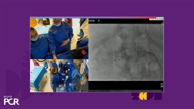 The turning point in hypertension care: Symplicity Spyral renal denervation in practice
