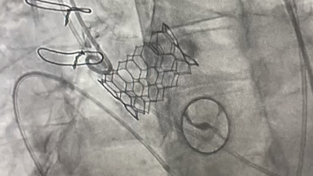 Align for the future with Myval THV series - From randomised trials to everyday clinical practice