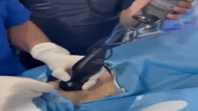 Femoropopliteal intervention