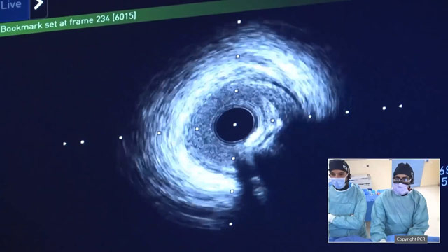 Left main bifurcation instent restenosis - LIVE case