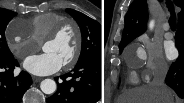 Management of coronary aneurysms