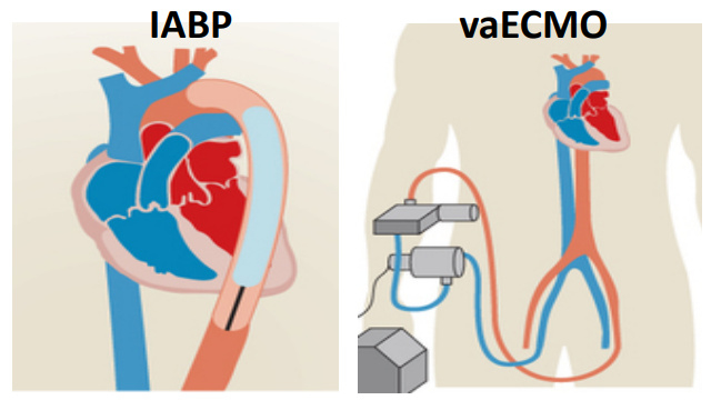 Mechanical circulatory support: role in the management of high-risk PCI and AMI-cardiogenic shock