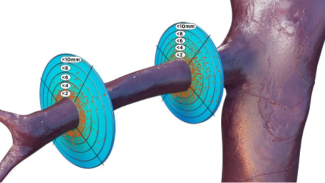 Renal denervation in 2024