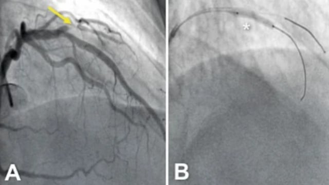 Revolutionising coronary care: the impact of drug-coated balloons in acute and chronic artery disease - A stentless future