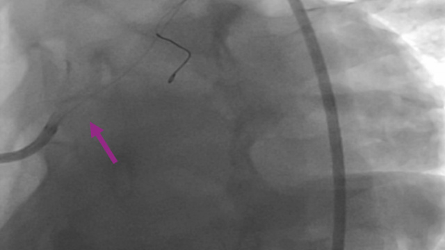 When complications storm through the cathlab #1