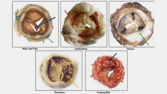 Multivalvular disease: mitral and aortic valve challenges explored