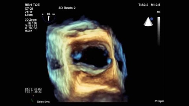 Optimizing case selection and procedure guidance in transcatheter mitral valve interventions