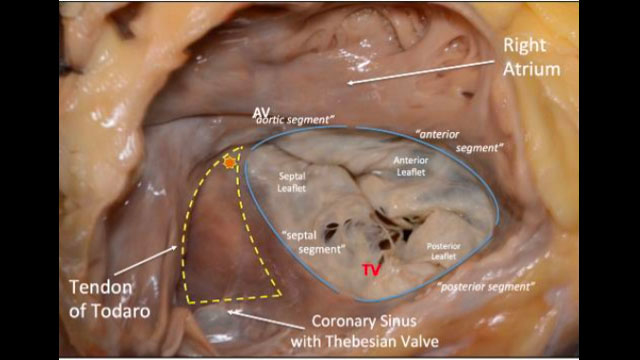 Tricuspid valve disease: diagnosis and classification
