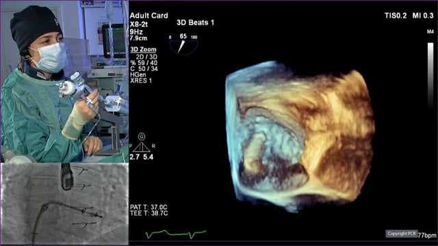Advanced mitral TEER - LIVE case
