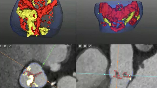 Early diagnosis and lifetime management of valvular heart disease: new tools and treatment paradigms