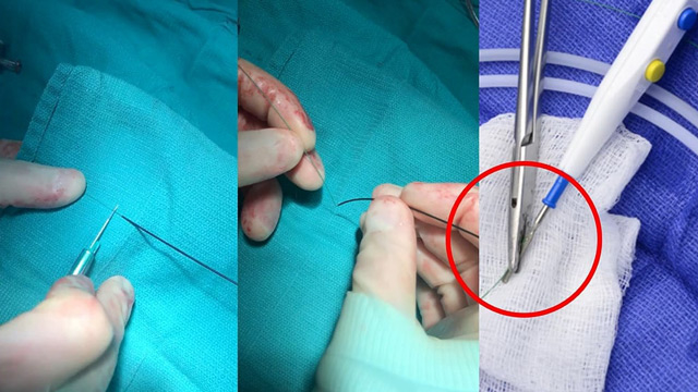 Electrosurgery and leaflet modification: addressing an unmet need for transcatheter valve interventions