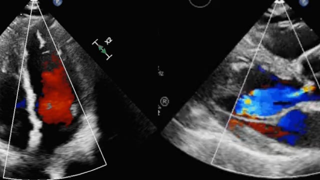Featured Cases - Challenging Mitral TEER (Part 1)