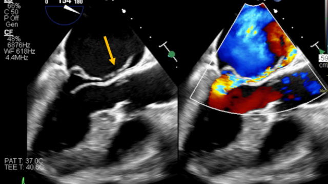 Featured Cases - Challenging mitral TEER (Part 2)