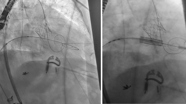 Featured cases - Combined valve interventions (Part 1)