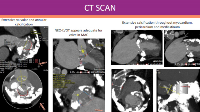 Featured cases - Mitral valve-in-valve (Part 1)