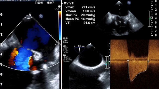 Featured cases - Mitral valve-in-valve (Part 2)