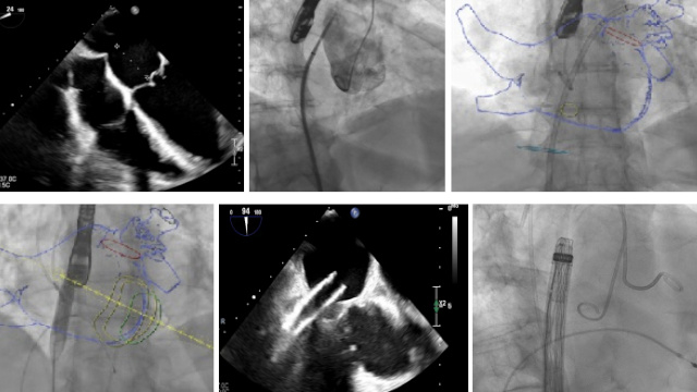 Featured cases - New TMVR devices