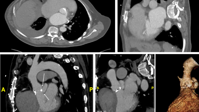 Featured cases - Paravalvular leak closure