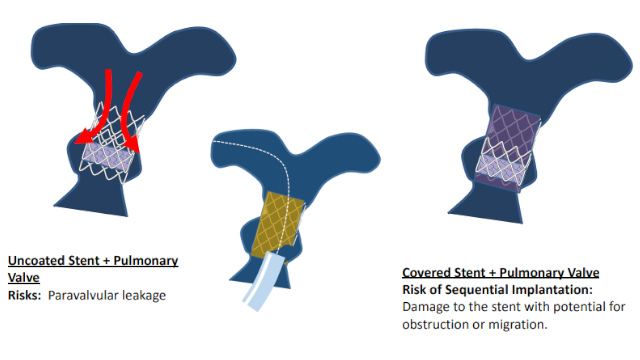 Featured Cases - Pulmonary valve intervention