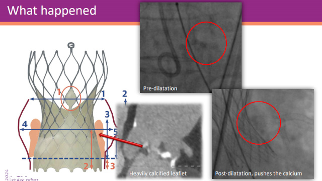 Featured cases - TAVI coronary complications