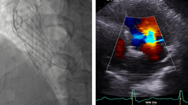 Featured cases - TAVI embolisation (Part 1)