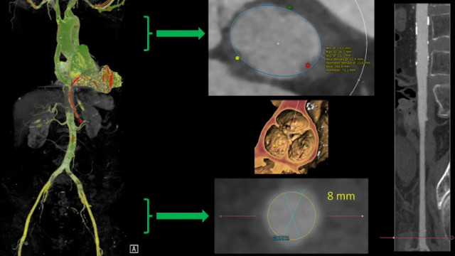 Featured cases - TAVI in aortic regurgitation