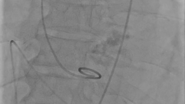 Featured cases - TAVI in bicuspid valve anatomy (Part 2)