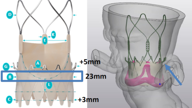 Featured cases - TAVI in SAVR (Part 1)