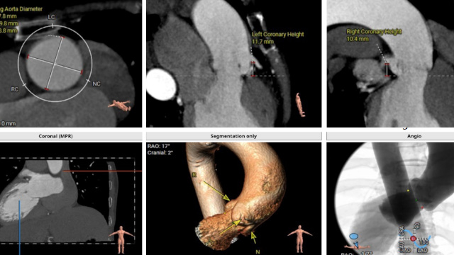 Featured cases - TAVI in unusual anatomical situations
