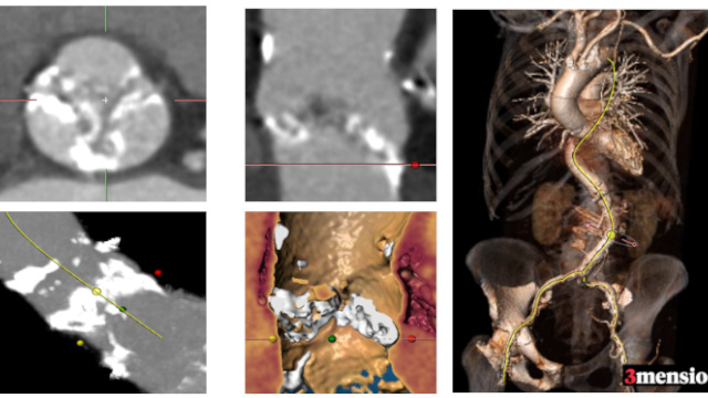 Featured cases - TAVI nightmares (Part 4)