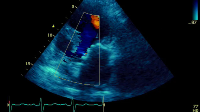 Featured cases - Transcatheter interventions in cardiogenic shock
