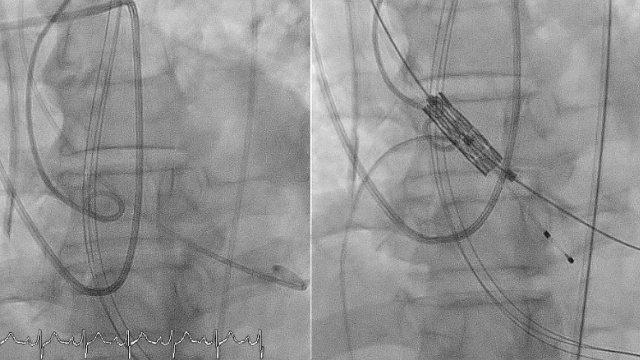 Featured research - Aortic valve (Part 3)