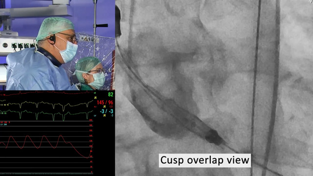 From index procedure to re-valving with a novel self-expanding valve