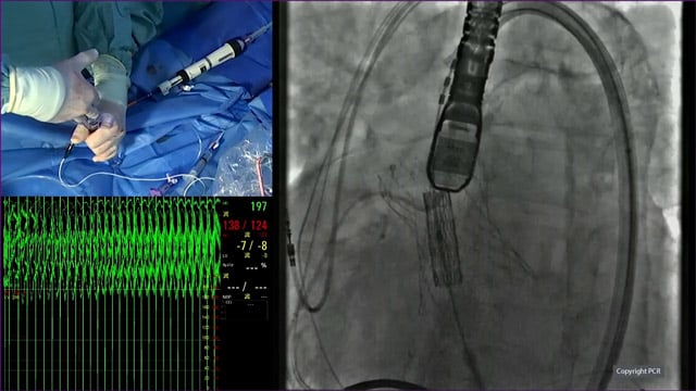 Leading innovation for patients with valvular heart disease