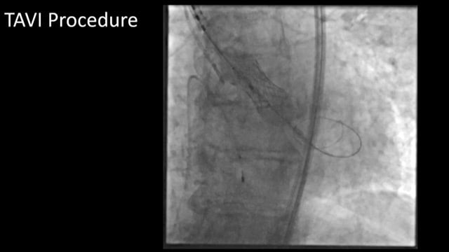 New frontiers in TAVI: have we reached them?