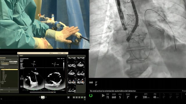 New technology for transcather valve replacement - LIVE Case