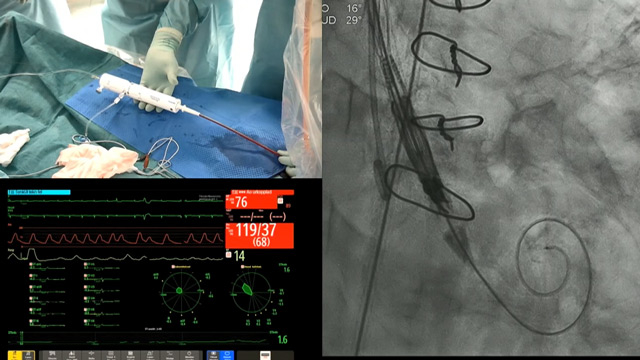 Optimisation of your valve implantation to ensure lifelong outcomes using a novel self-expanding valve