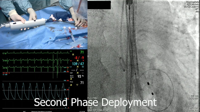 Optimising TAVI for bicuspid aortic stenosis: experience with a novel self-expanding system