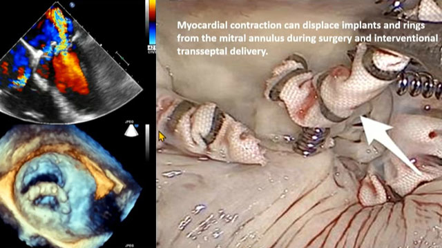 Parading the progress in transcatheter valve interventions