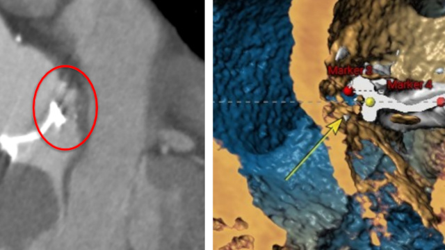 Rapid-Fire - Paravalvular leak closure