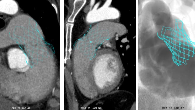 Rapid-Fire - Pulmonary valve interventions