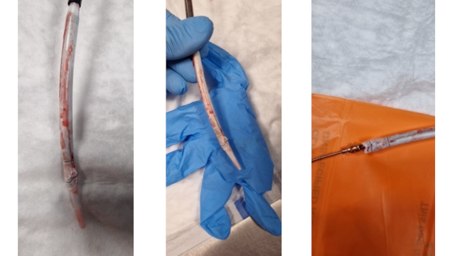 Rapid-Fire - TAVI complications: valve embolization, balloon ruptures & more!