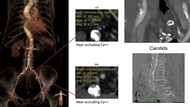 Rapid-fire - TAVI in challenging anatomy