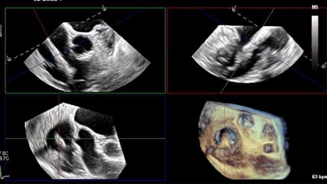Rapid-Fire - Transcatheter tricuspid valve replacement