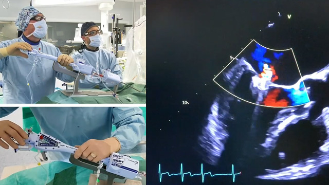 RESHAPING the transcatheter treatment of mitral and tricuspid regurgitation